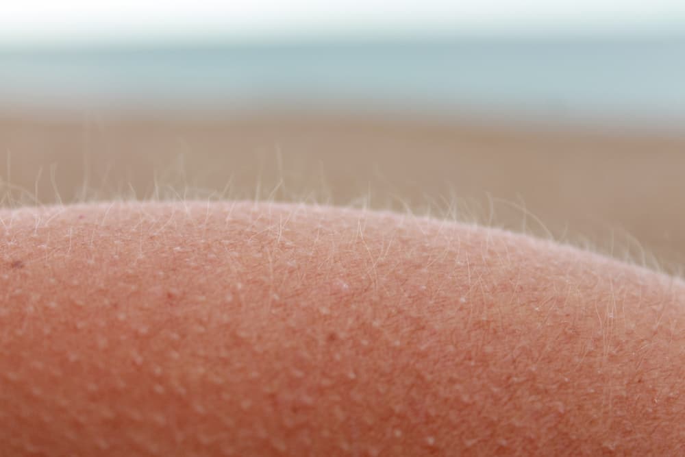 Visible goosebumps on human's arm